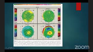 QUERATOMETRIA Y TOPOGRAFIA [upl. by Kori]