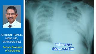 Pulmonary Edema on CXR [upl. by Qerat420]