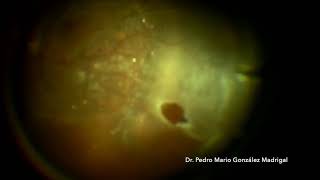 Vitrectomy for Rhegmatogenous Retinal detachment with PVR [upl. by Aohsoj]