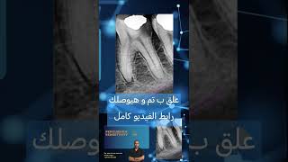 Clinical cases in Endodontics الكربولة endodontics dental [upl. by Kindig]