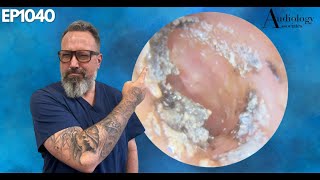 Removing Infected Ear Wax A Relief Like No Other  EP1040 [upl. by Ful]