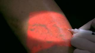 AccuVein Foam Sclerotherapy [upl. by Ahsir]