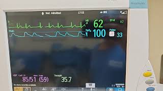 supraventricular trigeminy [upl. by Marchelle]