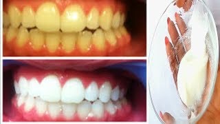 HOW I WHITEN MY BROWN TEETH AT HOME IN 5 MINUTES 100 WORKING [upl. by Aitak]