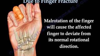 Finger Fractures Malrotation Of The Fingers  Everything You Need To Know  Dr Nabil Ebraheim [upl. by Zetes755]