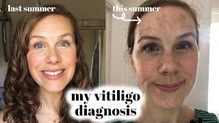 My Vitiligo Diagnosis [upl. by Gnuhp]