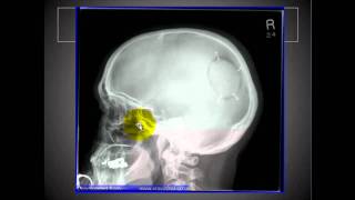 Lateral Skull and Sinusesmp4 [upl. by Elam]