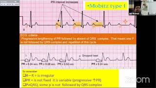 Session06Arrhythmia iiSVTAVRTAVNRT WPW VT by DrShahidullah Shamol [upl. by Ardnasil189]