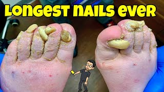 SUPER LONG TOENAILS CUTTING  AMAZING TRANSFORMATION [upl. by Forelli131]