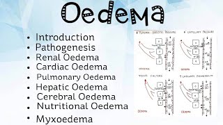 Oedema Pathology [upl. by Gorman700]