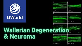 Wallerian degeneration amp neuroma  USMLE step 1 UWorld Questions Nervous system MBBS PLAB [upl. by Jerusalem]