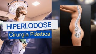 CIRURGIA PLASTICA  HIPERLODOSE [upl. by Oberon781]