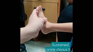 Ankle clonus in a child with cerebral palsy Shorts [upl. by Zetnwahs]