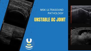 Unstable Acromioclavicular joint on ultrasound [upl. by Atinnek]