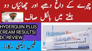 Hyderquin plus cream uses Melasma Hyperpigmentation freckle and acne scar treatment formula cream [upl. by Anna-Diane]