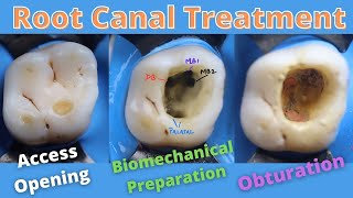 Root Canal Treatment in Maxillary First Permanent Molar 🟠 How to locate Mesiobuccal Canalsmb1mb2 [upl. by Zaob101]