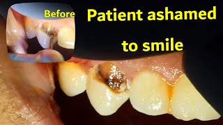 TEETH FILLING  Front Canine decay removal and bonding composite [upl. by Neraj]