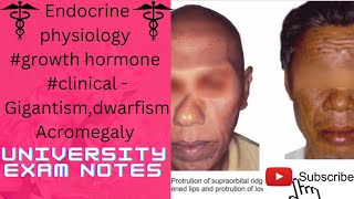 Growth hormone clinicalgigantismacromegalydwarfismmedicoscontent3135 [upl. by Dajma]