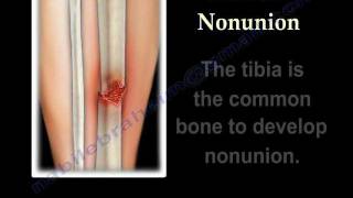 NONUNION OF FRACTURES CAUSES AND TREATMENT  Everything You Need To Know  Dr Nabil Ebraheim [upl. by Ailahs]