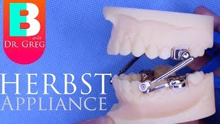 BRACES EXPLAINED Herbst Appliance [upl. by Uttasta526]