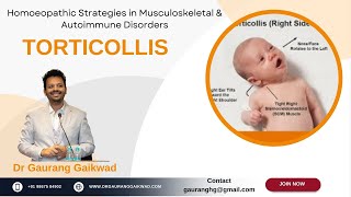 Homoeopathic Strategies in Torticollis Dr Gaurang Gaikwad [upl. by Nnylirret]