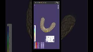 Exocad Veneer Design Tutorial  StepbyStep Digital Workflow for Perfect Smiles digitaldentistry [upl. by Sudderth]