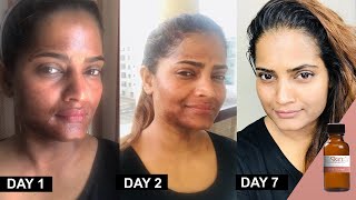 25 TCA Chemical Peel at home method and progress by Hina UrduHindi [upl. by Aitnohs]