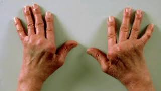 Jaccoud arthropathy vs Rheumatoid arheritis of hand  مراجعة [upl. by Stephana597]