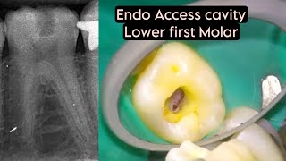 live ENDODONTIC ACCESS CAVITY preparation 1st LOWER MOLAR [upl. by Aititil]