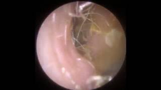 Endoscopic Removal of Soft Ear Wax  Mr Neel Raithatha The Hear Clinic  Leicester [upl. by Hadeehsar232]