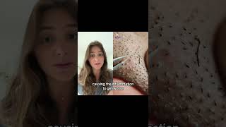 What happens when you extract your ingrown hairs with a tweezer ingrownhair ingrownhairremoval [upl. by Ebbie]