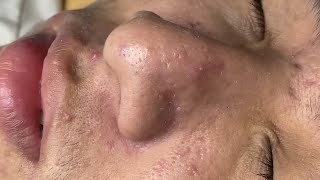 more face blackheads  dermacool 0117 [upl. by Christye]