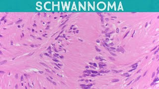 Schwannoma explained in 5 minutes Verocay bodies Antoni A amp B usmle nerve sheath tumor pathology [upl. by Ngo]