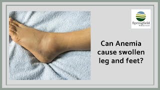 Can Anemia cause swollen leg and feet  Dr Maran on pitting pedal edema [upl. by Lorilyn]