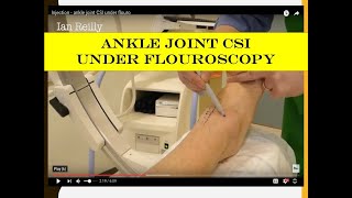 Injection  ankle joint CSI under flouro [upl. by Dunham263]