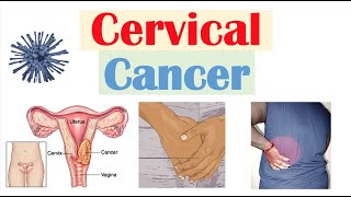 Cervical Cancer Risk Factors Pathophysiology Symptoms Staging Diagnosis Treatment amp Prevention [upl. by Redliw]