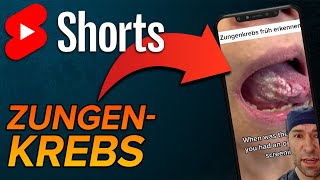 Zungenkrebs shorts [upl. by Treb]