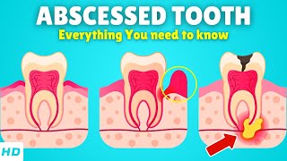 Abscessed Tooth – Causes Signs and Symptoms Diagnosis amp Treatment [upl. by Saxena]