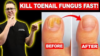 1 BEST Toenail Fungus Treatment Top 10 Home Remedies 2024 [upl. by Etireugram]