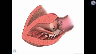 Surgical treatment for hypertrophic cardiomyopathy A historical perspective [upl. by Ydner]