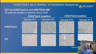 Targeting H3K27me3 loss in pediatric brain tumors [upl. by Trefor]