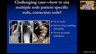 Adult Scoliosis and Spinal Deformity Surgery Update  UCSF Community Grand Rounds [upl. by Wj536]