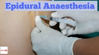 Epidural AnaesthesiaProcedure Of Epidural AnesthesiaContraindications to Epidural Anaesthesia [upl. by Alomeda]