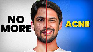 Get rid of PIMPLE amp ACNE Naturally  Real Causes amp Effective Solutions  Saurabh Bothra [upl. by Ida500]