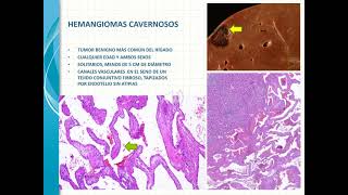 NÓDULOS Y TUMORES HEPÁTICOS [upl. by Peugia]