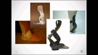 StepSmart for Drop Foot  Foot and Ankle Biomechanics [upl. by Clerissa]