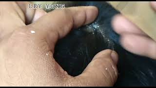 Dandruff Scratching  Dry Flaky Scalp \ Huge Flakes \Scalp Scratching  4 [upl. by Meggs]