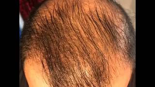 14 month’s using minoxidil  Rogaine 5 Before amp After results [upl. by Yerffoeg10]