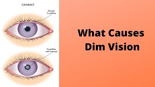 What Causes Dim Vision [upl. by Thoer742]