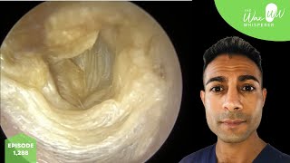 1288  Dead Skin Peel off Surgical Tympanoplasty Eardrum [upl. by Droffig649]